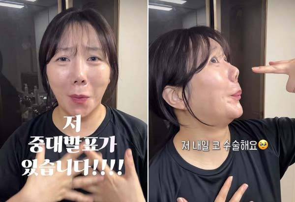 코미디언 허안나(41)가 과거 받았던 코 성형수술 부작용으로 재수술을 한다고 밝혔다./사진=허안나 인스타그램 캡처