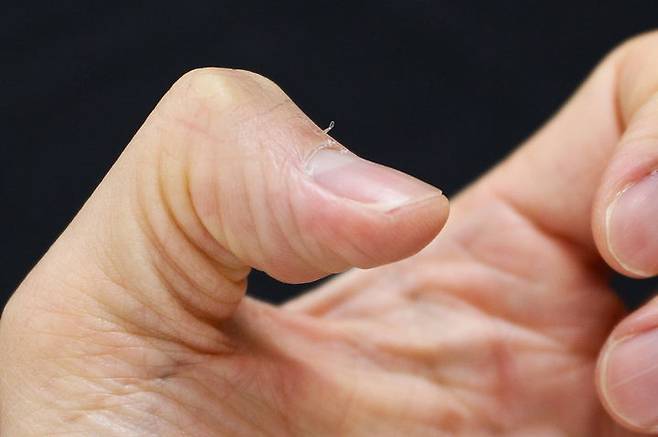 [서울=뉴시스] 15일 의료계에 따르면 생인손이라고도 불리는 조갑주위염은 손톱, 발톱 주변이 붓고 염증이 생기는 질환을 말한다. (사진=고대안산병원 제공) 2025.08.14. photo@newsis.com *재판매 및 DB 금지