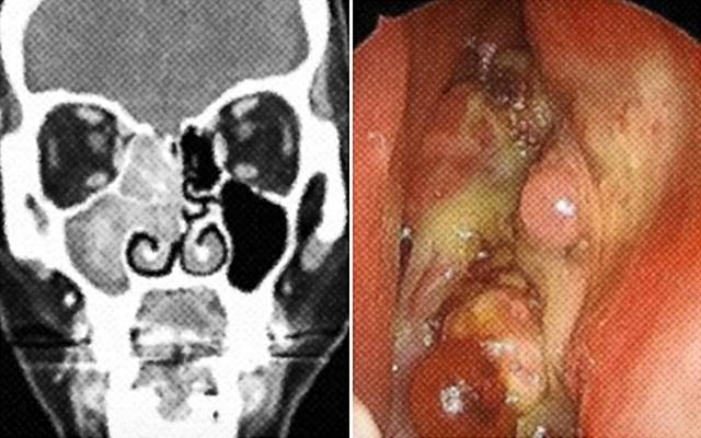 코 종양 자료사진. 서울아산병원 자료