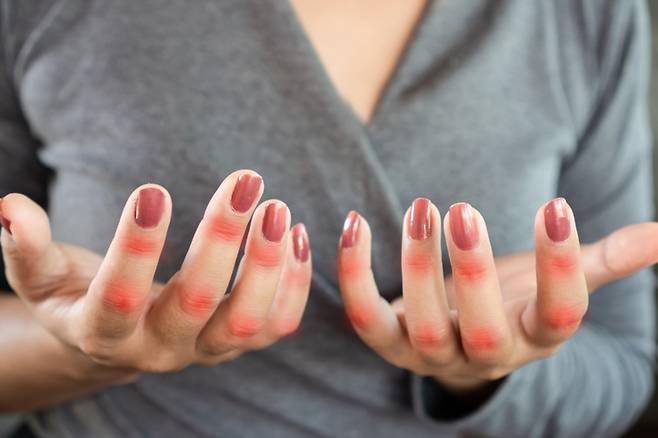 바람만 불어도 아프다는 통풍. 남성들의 주로 걸리는 질병으로 알려졌지만, 50대 이후 여성에서 환자가 크게 늘고 있. [사진=게티이미지뱅크]