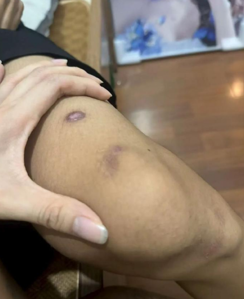 중국의 17세 여성이 2살 위 남자친구를 미얀마 범죄 조직에 팔아 넘긴 돈으로 해외 여행을 떠났다가 체포됐다. 범죄조직에서 극적으로 탈출한 19세 남성 피해자 몸에 남은 상처