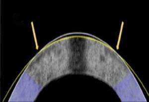 토끼 각막 교정 이미지