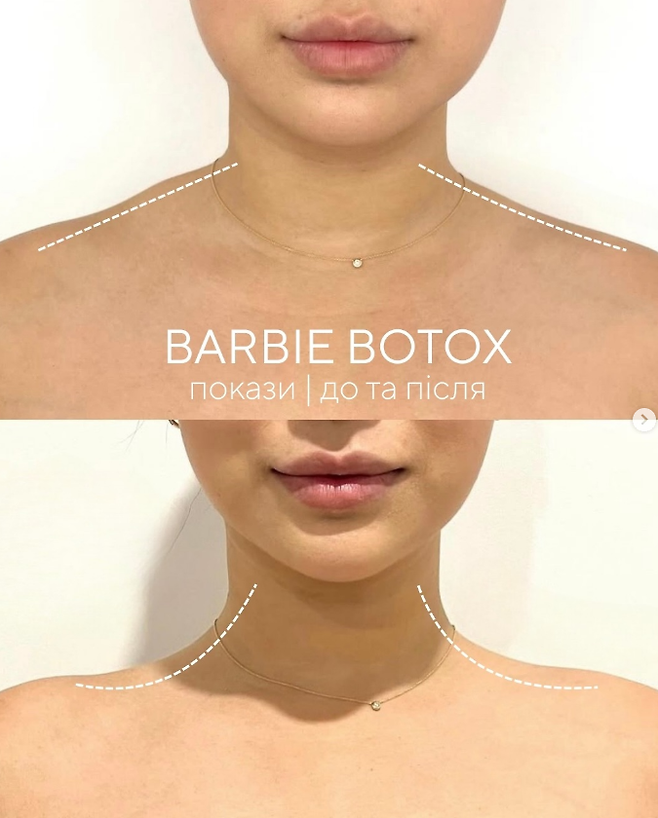 바비보톡스 광고물. [사진 = 인스타그램 @new_derm_clinic]