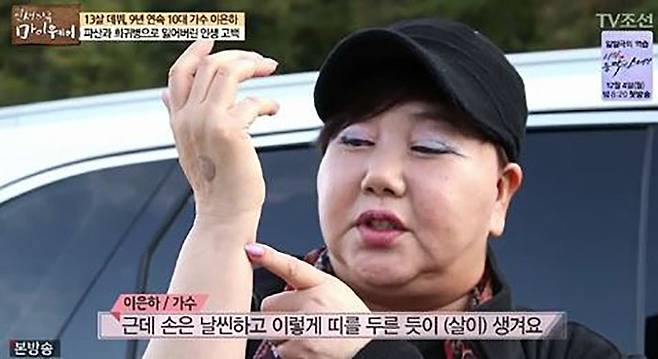 가수 이은하도 앓고 있는 ‘쿠싱증후군’ (TV조선 ‘스타다큐 마이웨이‘ 캡처)