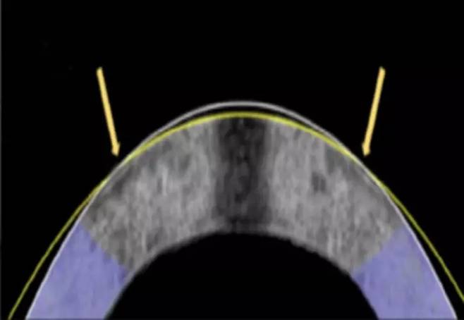 전기기계적 재성형으로 각막이 평평하게 변형됐다. 원래 각막(흰색 선)과 성형 후 각막(노란색 선). 사진=Daniel Kim and Mimi Chen
