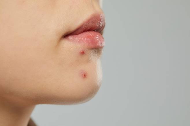 여드름은 피부 속에서 발생하는 만성 염증성 질환이며 호르몬과 각질, 세균, 염증 등이 복합적으로 얽혀 생긴다. 생활 습관과 식습관을 개선하는 등의 노력에도 나아지지 않는다면 최대한 빠르게 전문의에게 치료받는 것이 중요하다. 여드름을 방치할 경우 색소 침착이나 흉터로 이어지기도 한다. 특히 두피에 나는 여드름이 흉터로 변한다면 그 자리에 모발이 자라지 않는 흉터성 탈모가 생길 수 있어 주의가 필요하다. 사진: 파이낸셜뉴스DB