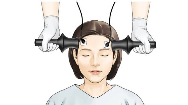 ECT는 뇌에 짧은 전기 자극을 가하는 치료법으로 다양한 정신질환 치료에 사용된다｜출처: 서울아산병원