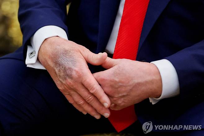25일(현지시간) 백악관에서 열린 한미정상회담 도중 도널드 트럼프 미국 대통령의 오른손 손등에 멍으로 보이는 검푸른 자국이 포착됐다.[로이터=연합뉴스. 재판매 및 DB 금지]