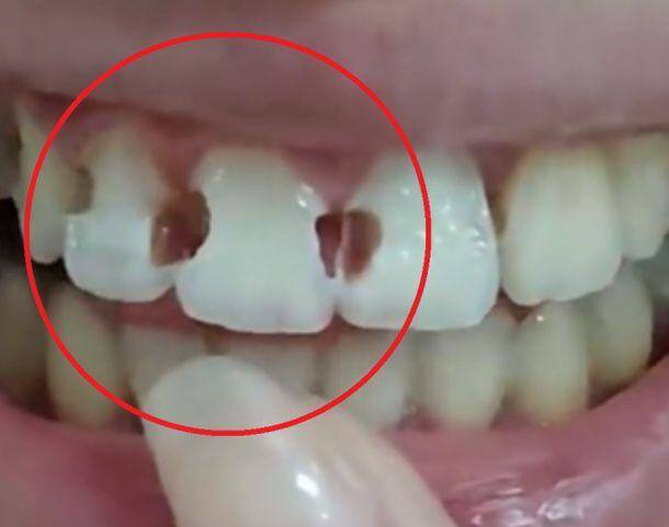 5년간 치아 교정 치료를 받아 온 중국 여성의 치아 상태./웨이보