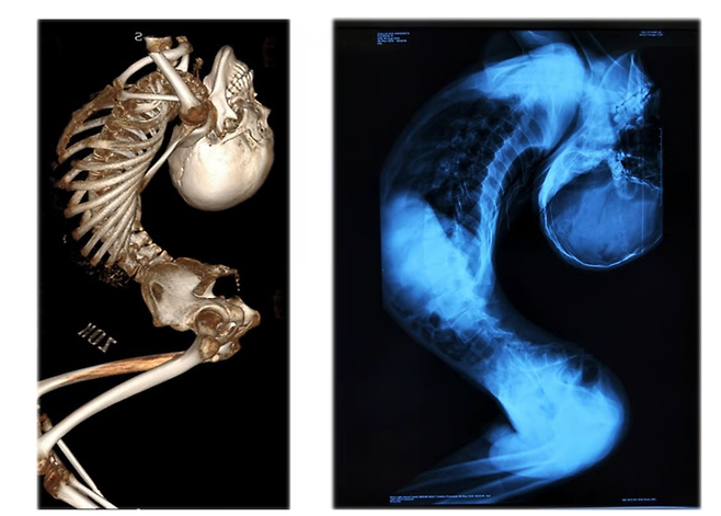 2024년부터 장옌천은 척추 기형 치료로 유명한 량이젠 교수의 치료를 받기 시작했고, 올해 6월 마지막 수술을 마쳤다. Handout