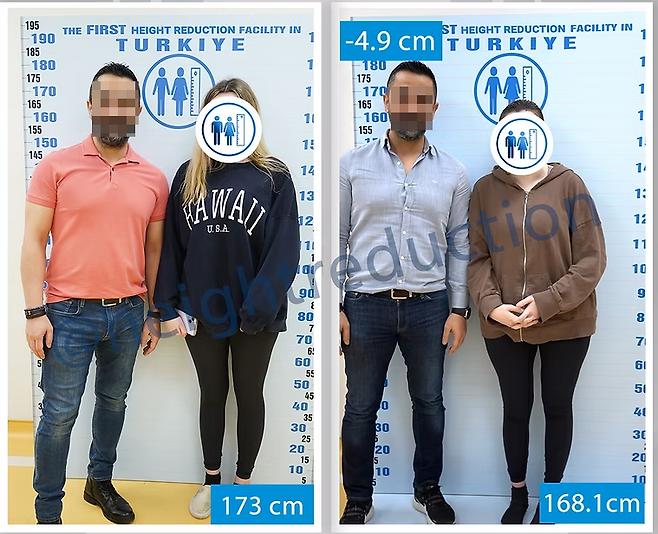 터키 병원에서 실제 ‘키 축소 수술’을 받은 여성의 전후 사진. 왼쪽은 수술 전(173㎝), 오른쪽은 수술 후(168.1㎝) 모습으로, 함께 선 남성은 담당 의사다. [Height Reduction 공식 홈페이지]