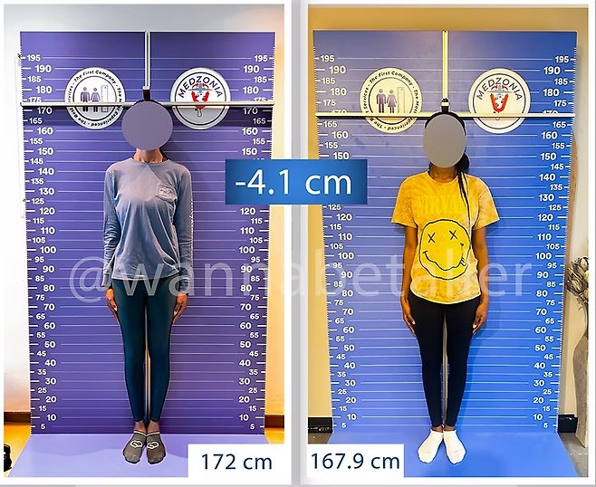 터키 병원에서 실제 ‘키 축소 수술’을 받은 미국 여성 A씨의 전후 사진. 수술 전(172㎝)에서 수술 후(167.9㎝)로 약 4.1㎝ 줄었다. [Height Reduction 공식 홈페이지]