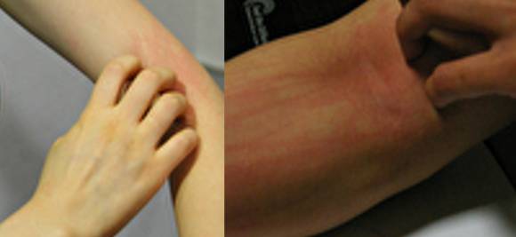 아토피 피부염은 가려움증과 피부 건조증을 동반하는 질환이다. [사진=아이뉴스24DB]