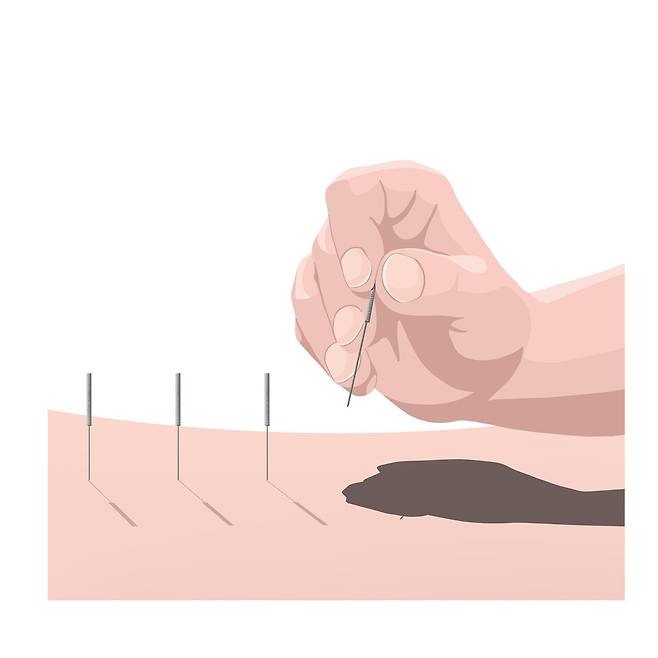29일 법조계에 따르면, 제주지방법원 형사2단독(배구민 부장판사)은 보건범죄 단속에 관한 특별조치법 위반(부정의료업자) 등 혐의로 구속기소된 A씨(76)에게 징역 2년4개월과 벌금 500만원을 선고했다. 2022년부터 약 4년간 전국을 돌며 무면허 침 시술을 자행해 폭리를 취하고 환자들로 하여금 각종 부작용을 겪게한 혐의다. ⓒ연합뉴스=OGQ&nbsp;