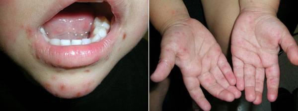 수족구병은 장바이러스에 의해 손, 발, 입에 3~7mm 크기의 붉은 반점이나 수포성 발진이 생기는 질환이다.​/부속사진=클립아트코리아