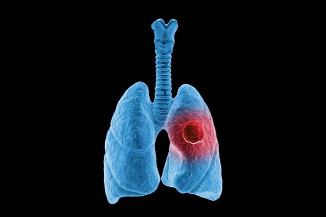 폐암 재발 가능성을 유의미한 수준으로 예측할 수 있는 인공지능(AI) 모델이 등장했다. 게티이미지뱅크 제공.