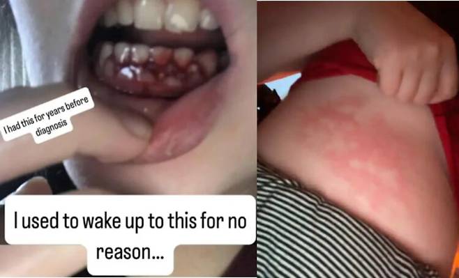 치과 문제로 시작된 단순한 잇몸 출혈이 사실은 혈액암의 신호였다는 한 20대 여성의 사연이 전해졌다.  [사진=SNS]