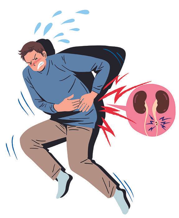 신장결석은 체내 칼슘옥살레이트(옥살산칼슘) 생성과 관계가 있다. GETTYIMAGES