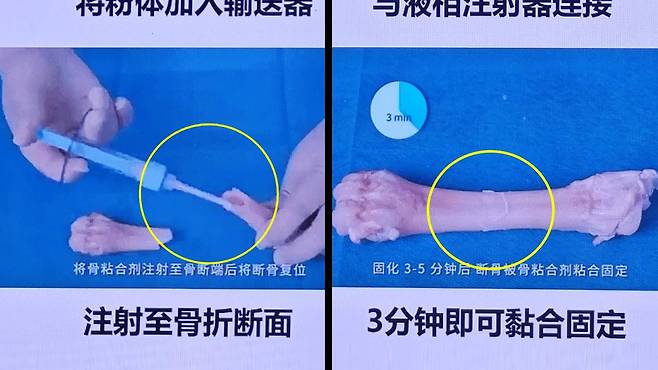 의료용 접착제 'Bone-02'를 사용한 수술 단계 모습 / 중국 과학기술일보 보도화면