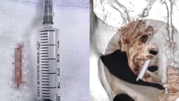 다행히 후 씨는 수술을 받고 이물질을 꺼내는 데 성공했다고 한다. 사진은 해당 여성의 엑스레이. [사진=바이두 갈무리 ]