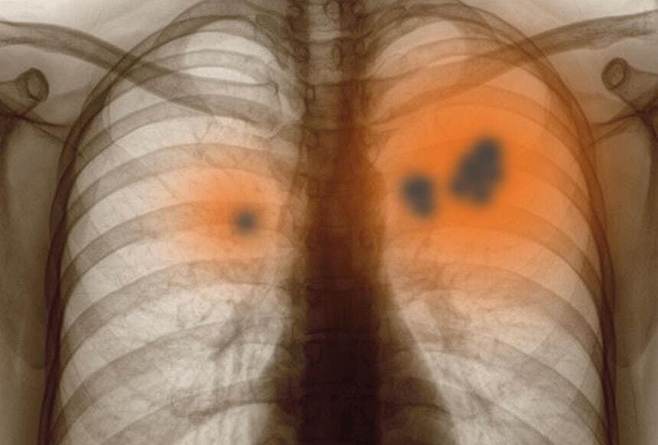 내년부터 56살, 66살 국민은 국가건강검진에서 폐기능 검사를 받을 수 있게 된다. 게티이미지뱅크