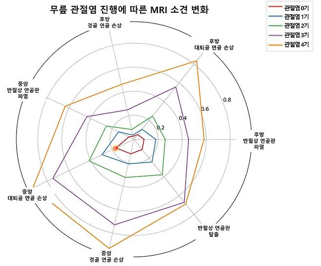 무릎 관절염 진행 단계에 따른 MRI 소견. 관절염 0기(빨간 선)에서도 ‘중앙 대퇴골 연골 손상’이 관찰돼, 이 손상이 무릎 관절염의 중요한 초기 증상으로 나타났다.