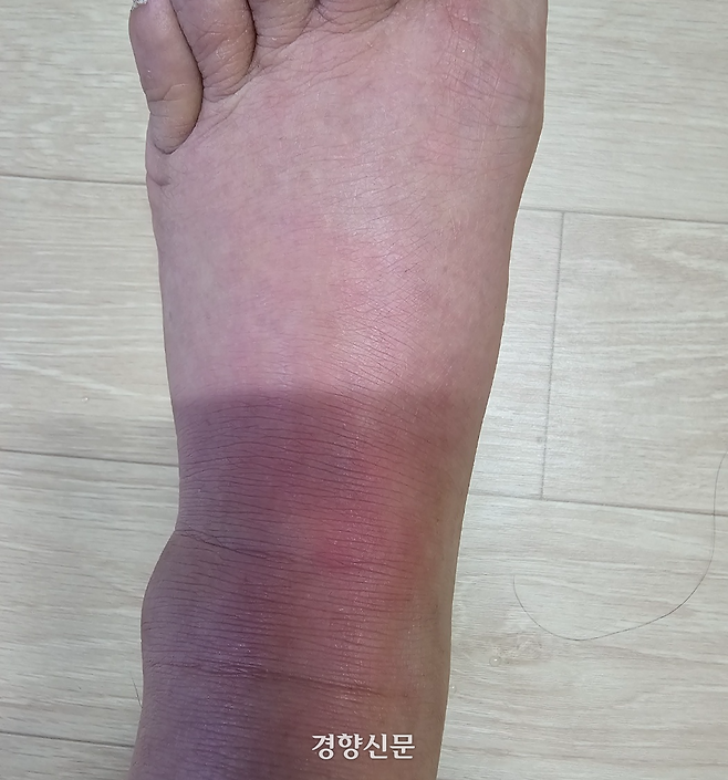 환경미화원 신재삼씨(60)의 발이 쓰레기에서 나온 오물에 의한 감염으로 부어 있다. 신재삼 제공