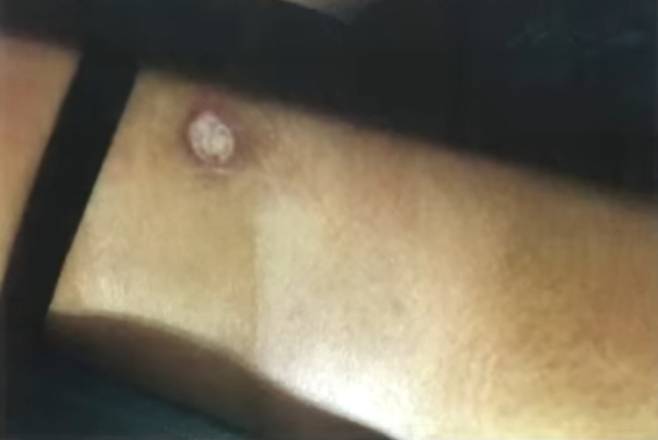 숨진 A양의 어깨에 남겨진 담배빵 자국. [JTBC ‘사건반장’]