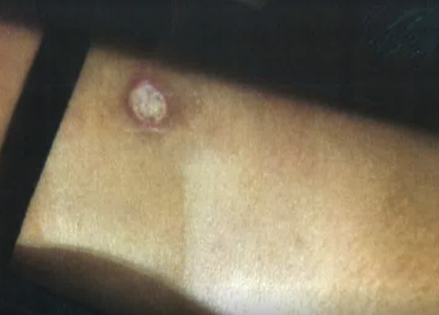 A양 어깨의 화상자국. JTBC 사건반장