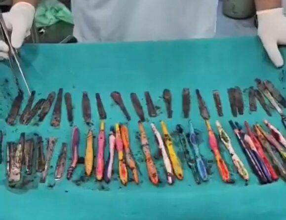 복통을 호소해 병원으로 이송된 30대 인도 남성의 뱃속에서 숟가락, 칫솔 등 50개의 이물질 나왔다. 사진=데브 난디니 병원 제공