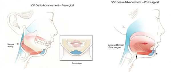 턱끝뼈가 앞으로 전진되면서 아래턱뼈 안의 공간이 넓어지는 효과가 있습니다. 사진=Stanford Sleep Surgery