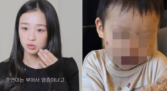 손연재의 아들이 스키터 증후군을 앓는 것으로 알려졌다. 스키터 증후군 환자는 모기에 물렸을 때 남들보다 심하게 피부가 부풀어 오르는 증상을 겪는다. 동시에 화끈거림과 가려움, 통증 등을 호소한다.