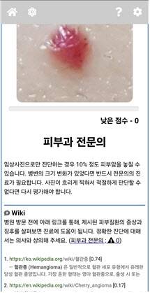 ModelDerm 어플리케이션 사용 화면. 피부 병변 사진을 업로드하면 알고리즘이 질환을 구분한다.