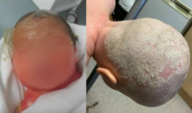 선천성 어류비늘증(Congenital Ichthyosis, CIE)의 사례. SNS 갈무리