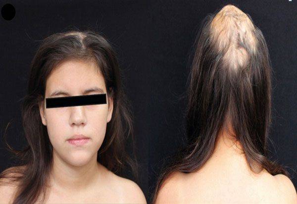 아담스-올리버 증후군으로 인해 정수리 부위에 넓게 탈모가 진행된 13세 소녀./사진=임상사례보고저널