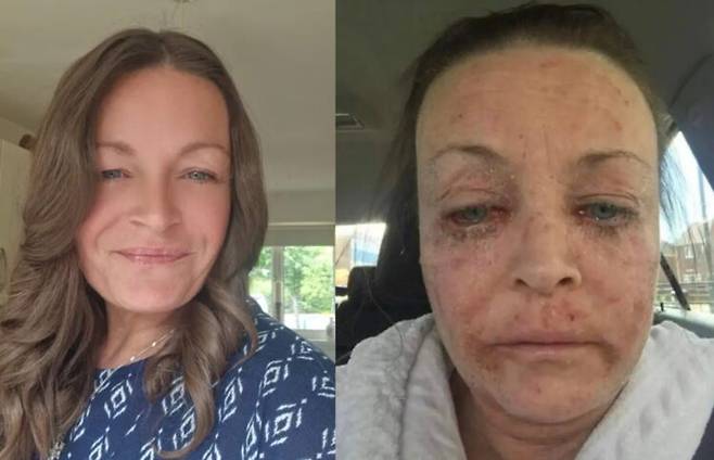 아버지 죽음 이후 처음엔 잠들기 전 한 잔으로 시작된 음주가 곧 하루 종일 이어졌고, 결국 그의 몸과 정신은 서서히 무너져갔다. 오른쪽 모습은 알코올중독으로 인해 얼굴이 망가진 모습. 사진=선덜랜드의 중독 회복단체