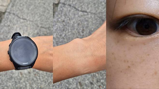 달리기 훈련 여파로 그을린 피부와 늘어난 주근깨 시계 모양에 따라 타버린 팔목과 얼굴에 수없이 늘어난 주근깨. 대부분 러너가 공통적으로 겪는 현상이기도 하다.