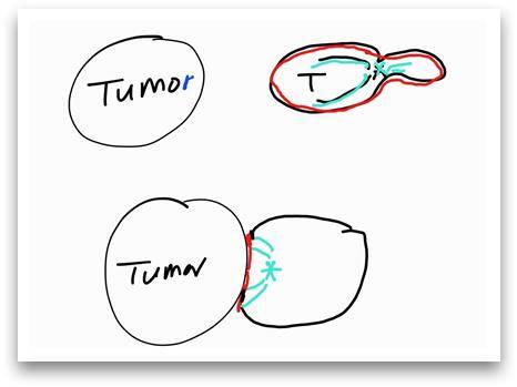 ▲그림2 최은영 교수가 그린 T세포가 종양세포(Tumor)에 상호작용하기 전(위) 그림과, 밀착한 모습(아래). T세포 내부에서 보통 때는 액틴(붉은 색)은 세포의 바깥쪽에 흩어져 있고, 미세소관(푸른색)은 뒤의 꼬리 부분 가까이에 있다. T세포가 종양세포에 밀착하면 액틴과 미세소관의 배열이 달라지는 재구조화가 일어나고, 면역 시냅스가 두 세포의 밀착면에 형성된다. 빨강으로 칠해진 액틴이 접착제처럼 많이 나와 있고, 그 뒤에 푸른색의 미세소관이 자리 잡고 있다. ⓒ최은영