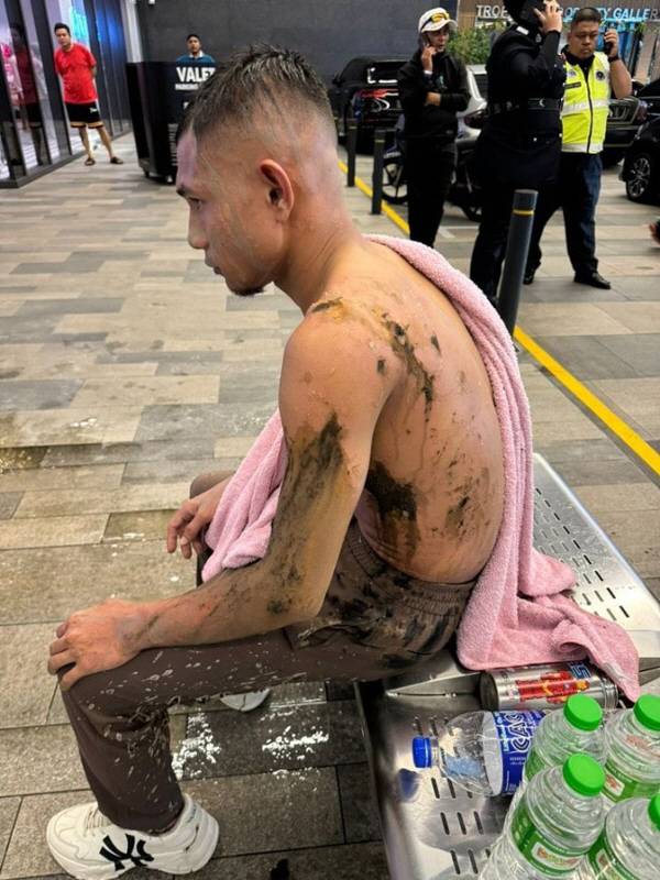 염산 테러를 당한 직후 모습.