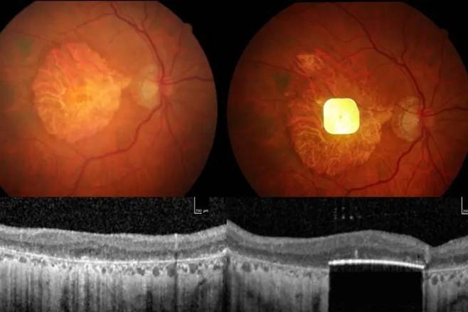 칩 삽입 전(왼)과 후의 모습 [무어필즈 안과병원 홈페이지 캡처. 재판매 및 DB 금지]