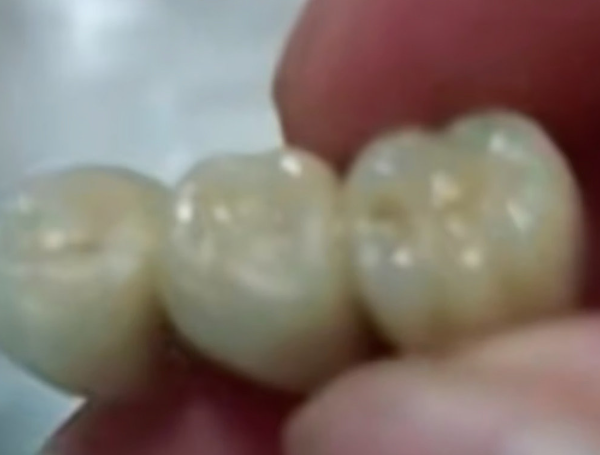 중국 북동부 지린성의 한 여성이 산 소시지에서 발견된 인공 치아 세 개의 모습. 사진=웨이보 캡쳐