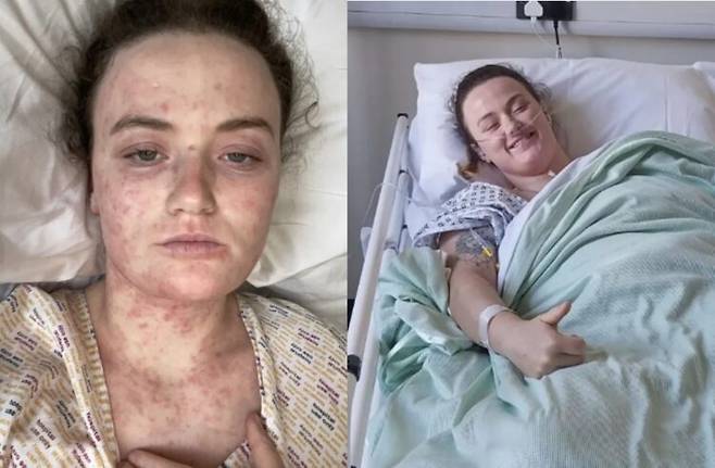 운동 후 생긴 엉덩이와 허리 통증을 단순 좌골신경통으로만 오진 받다가 치명적 감염으로 번지며 죽을뻔 한 20대 여성의 사연이 공유됐다. 사진=SNS