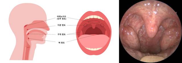 편도의 구조(왼쪽)와 편대 비대로 인해 코골이가 유발되는 성인 환자의 구강 내 사진. 사진 제공=서울대병원