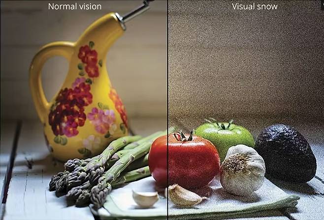 정상적인 사람의 시각(왼쪽)과 시각적스노우증후군 환자의 시각(오른쪽) 사이에는 큰 차이가 있다. 시각적스노우증후군 환자는 어둠 속에서도 눈보라 같은 것이 사라지지 않는다고 호소한다. 사진= 위키피디아(Francesca Puledda, Christoph Schankin, & Peter J. Goadsby/Wikipedia, CC BY-NC)