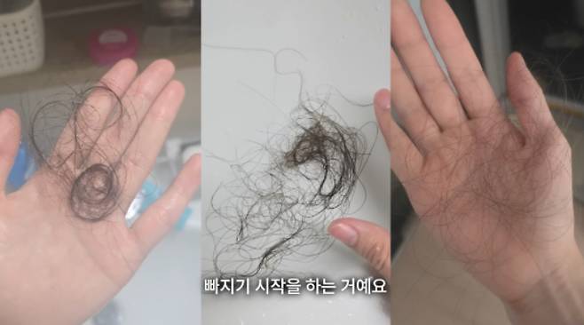 약물 과다 복용으로 인해 탈모 증세를 겪고 있는 모습. 유튜브 영상 캡처