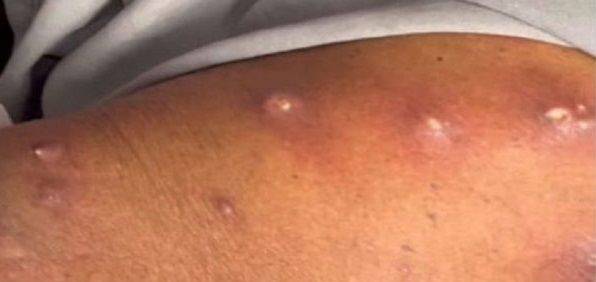 피내구더기증에 걸린 인도 남성의 모습. 사진=American Journal of Medical Science and Innovation 캡쳐