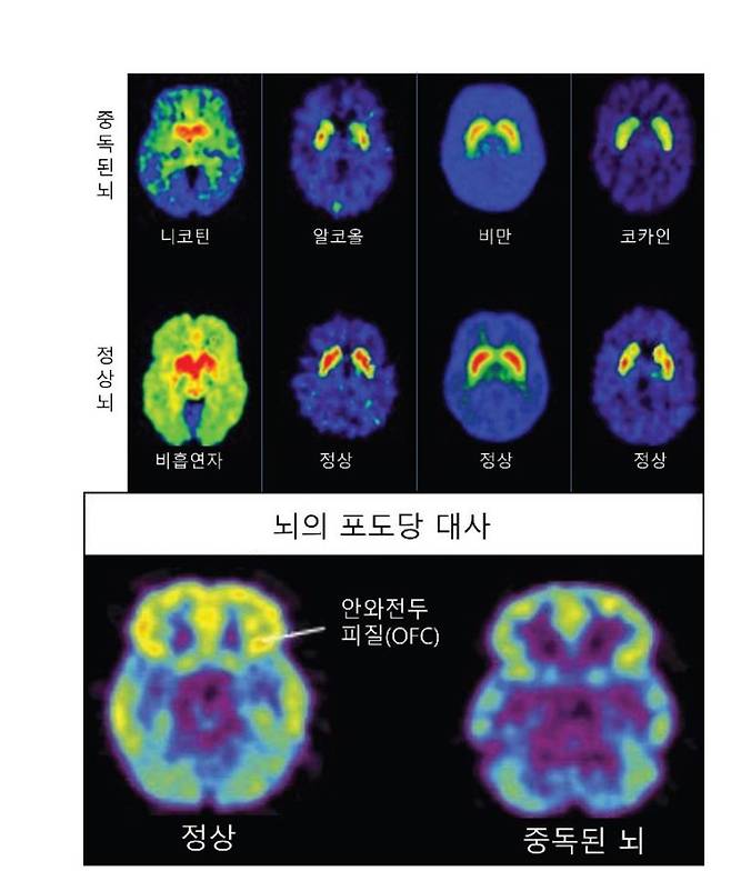 뇌가 보내는 SOS, 도파민 중독의 함정에서 벗어나기