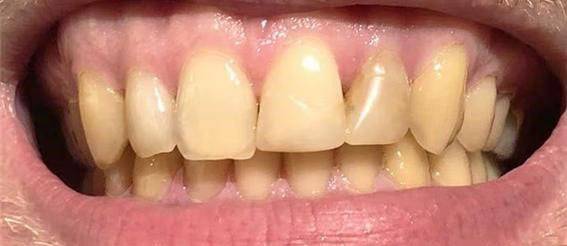 꼼꼼히 양치질해도 자주 먹는 음식 때문에 치아가 누렇게 변할 수 있다는 경고가 나왔다./사진=데일리메일