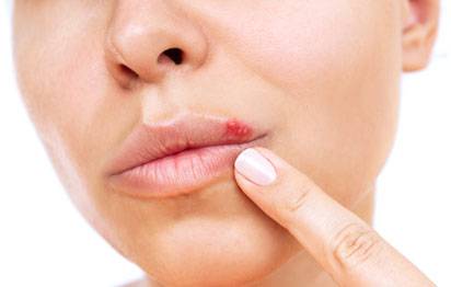 면역력이 떨어지면 입술 포진이 발생한다./사진 제공 = 게티이미지뱅크