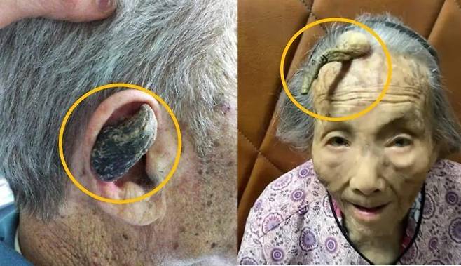의학적으로 '피부각종' 혹은 '피부각'이라 불리는 질환이다. 사진 왼쪽=귀에 생긴 피부각_위키피디아 /오른쪽=이마에 10cm 뿔이 난 중국의 첸 할머니_중국판 틱톡 더우인